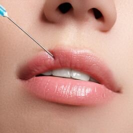 Injection acide hyaluronique pour embellir vos lèvres à Toulouse